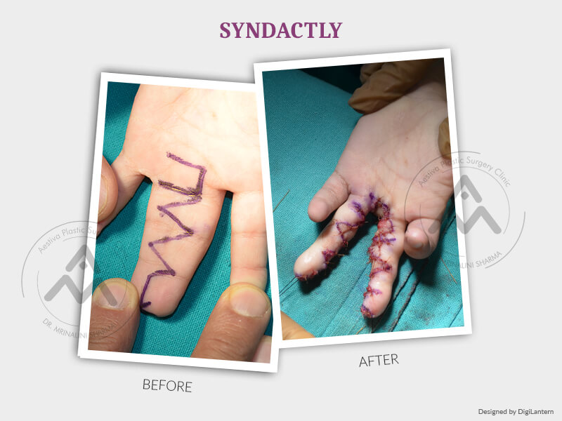 Syndactly