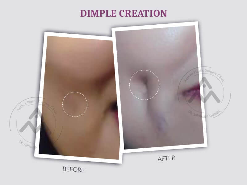 Real Results | Before and After results of Dimple Creation